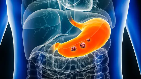 Detecting Stomach Cancer Early - Symptoms, Tests, and Prevention