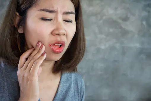 How to Heal Cracked Lip Corners Fast