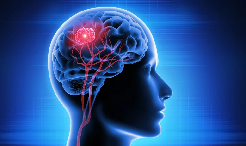 How To Prevent Brain Tumors How To Prevent Brain Tumors