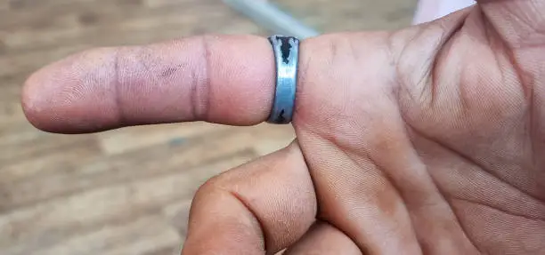 How To Remove A Ring From A Swollen Finger How To Remove A Ring From A Swollen Finger