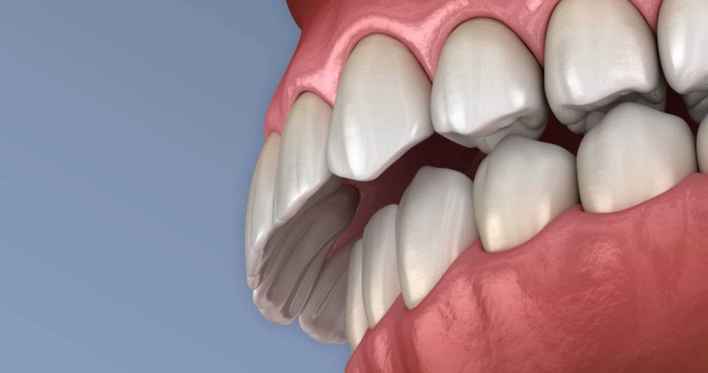 How To Fix An Overbite