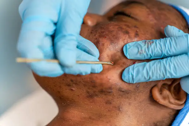 How to Remove Dark Spots Caused by Pimples How to Remove Dark Spots Caused by Pimples