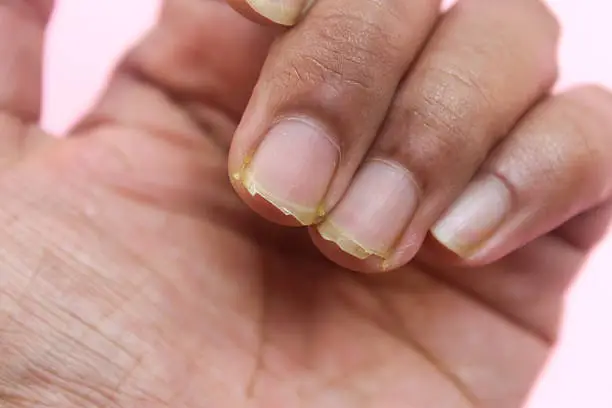 How to Remove Turmeric Stains from Nails How to Remove Turmeric Stains from Nails