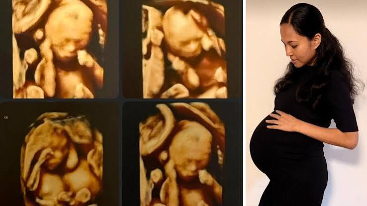 Rare identical quadruplets born in Australia Rare identical quadruplets born in Australia